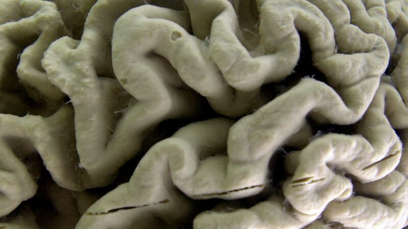 ARCHIVO - Un cerebro humano afectado por la enfermedad de Alzheimer se ve expuesto en el Museo...